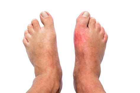 Bunion vs. Gout: What Is the Difference? - Upstep Answers