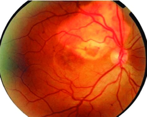 Color fundus photograph of the right eye. | Download Scientific Diagram