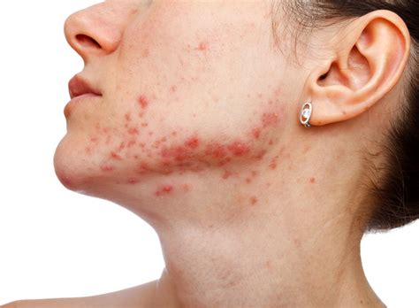 Accutane Treatment for Acne | U.S. Dermatology Partners