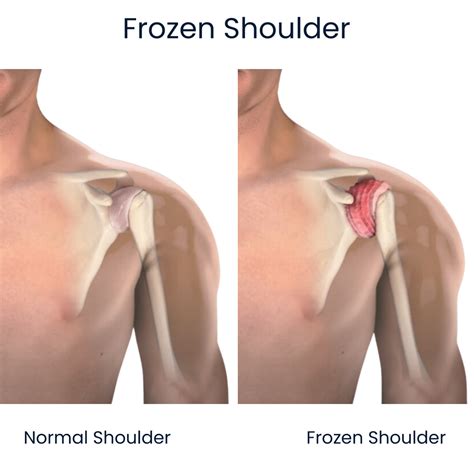 Frozen Shoulder Treatment NYC | Shoulder Pain Doctors New York