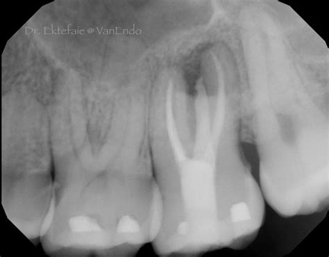 A Compromised Tooth is Still a Tooth – EndoLounge