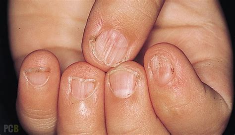 Vitamin D Deficiency Nails / Vitamin D deficiency symptoms: Peeling ...