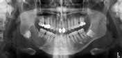 Dentigerous cyst | Radiology Reference Article | Radiopaedia.org