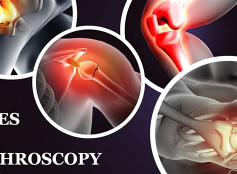 Arthroscopy: Purpose & Procedure – Welcome to SYS Medtech International Pvt. Ltd.