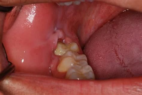 Inflamed Gums From Wisdom Teeth - Wisdom Teeth Factory