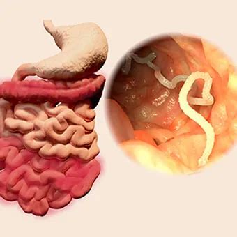 How To Detect Worms In Humans - Phaseisland17