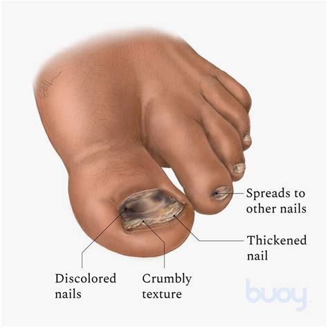 Black Spot On Toenail Near Cuticle - Nail Ftempo