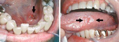 Oral Cancer Guide: Causes, Symptoms and Treatment Options