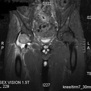 MRI of the pelvis showing effusion with soft tissue swelling and ...