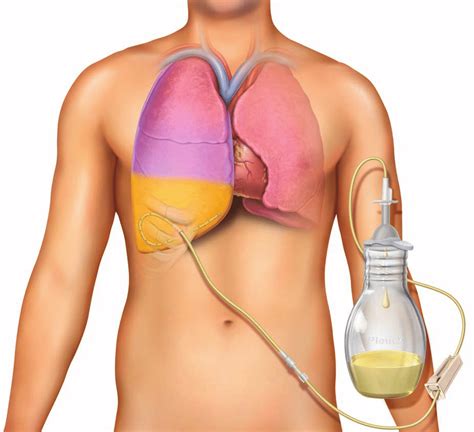 PleurXTM indwelling pleural catheter Courtesy and © Becton, Dickinson... | Download Scientific ...