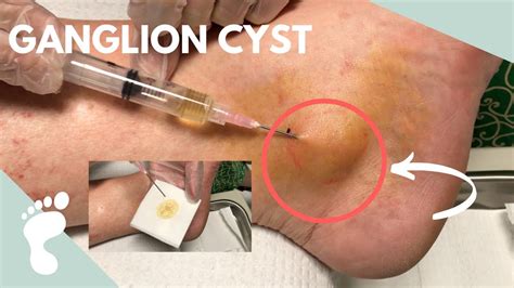 Do You Have A Ganglion Cyst Orthopedic And Sports Medicine | Images and Photos finder