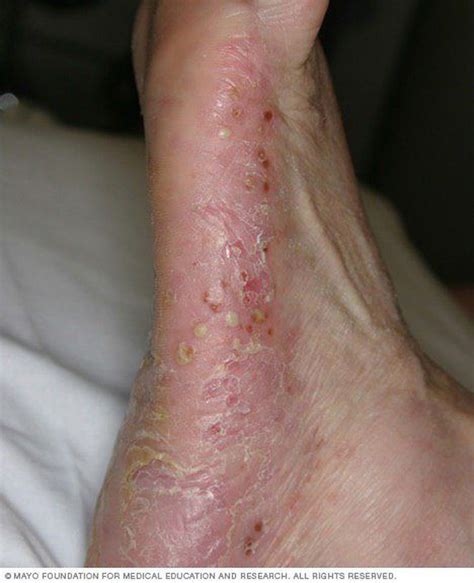 Pustular psoriasis - MEDizzy