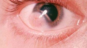 Cyst on Eyeball, Inside, behind, Causes, Pictures, Dermoid, Small Clear ...