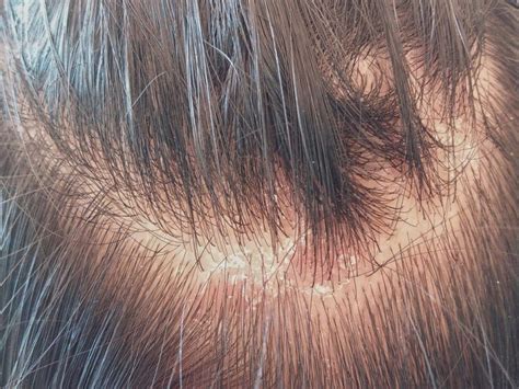 Yeast Infection On Scalp Hair Loss: Causes And Treatment – MartLabPro