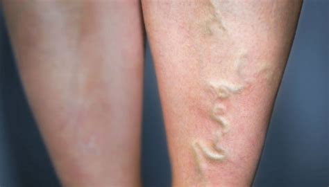 The Role of Genetics in Varicose Veins: Are You at Risk? - Jaimes Medical Group & The Vein ...