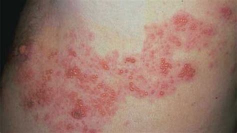 "Understanding Shingles: Causes, Symptoms and Prevention - Knellipedia" - Archyde