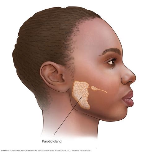 Parotid Gland Tumor Symptoms