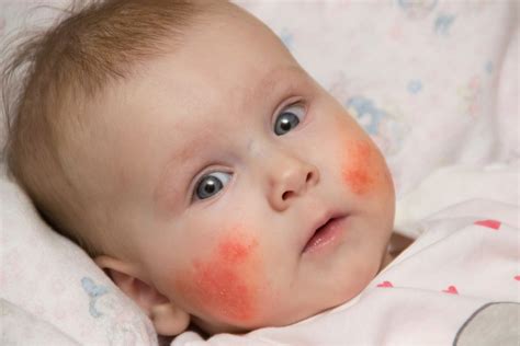 Why is Eczema worse in winter? - Qoctor your quick online doctor