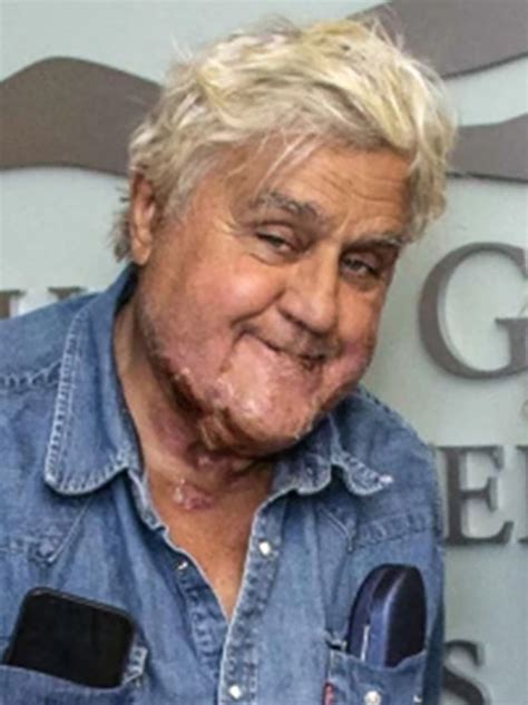 Trending Global Media Jay Leno reveals facial scars as he’s discharged from hospital burn unit