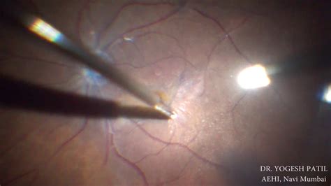 Epiretinal Mebrane Peeling (ERM Peeling) performed by Dr Yogesh Patil, Vitreo-Retina Surgeon ...