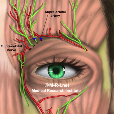 Supraorbital / Infraorbital nerve blocks for migraine – 6 months follow up – Mrimigraine.com