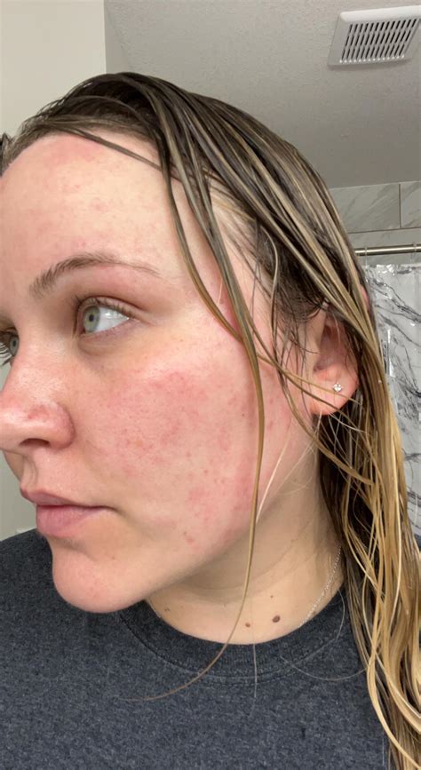 Redness and splotches after showering : r/Skincare_Addiction