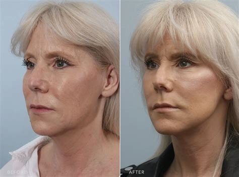 What Is a Deep Plane Facelift? | Williams Center Williams Center