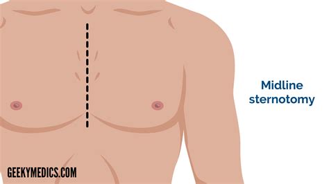 Cardiothoracic Incisions | Scars | Sternotomy | Thoracotomy | Geeky Medics