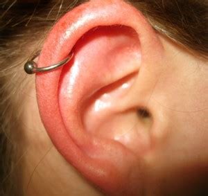 Infected Cartilage Piercing - Signs, Symptoms, Bump, Treatment, Pictures, Healing
