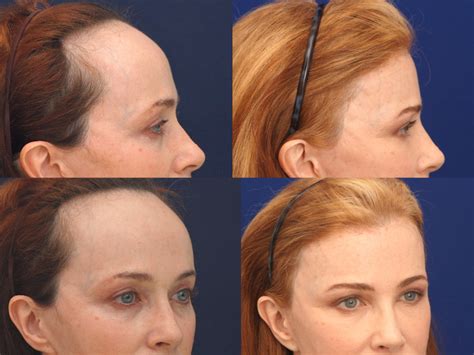 Forehead Reduction Surgery: Cost, Before and After Photos - Business ...