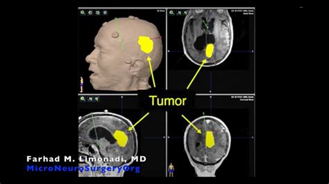 Brain Surgery: Removal of brain tumor after radiosurgery, with radiation necrosis - YouTube