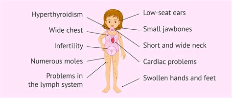 What is Turner syndrome? Its causes, characteristics and pregnancy