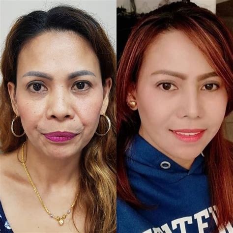 Filipino Nose Job Before And After