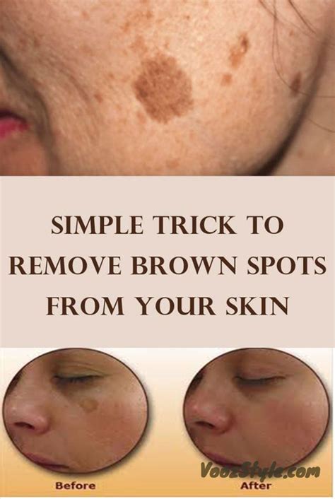 Simple Trick To Remove Brown Spots From Your Skin | Skin solutions, Home remedies for skin ...