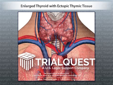 Enlarged Thyroid with Ectopic Thymic Tissue - TrialExhibits Inc.