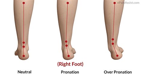Foot Pronation: Underpronation & overpronation explained- The Foot Clinic