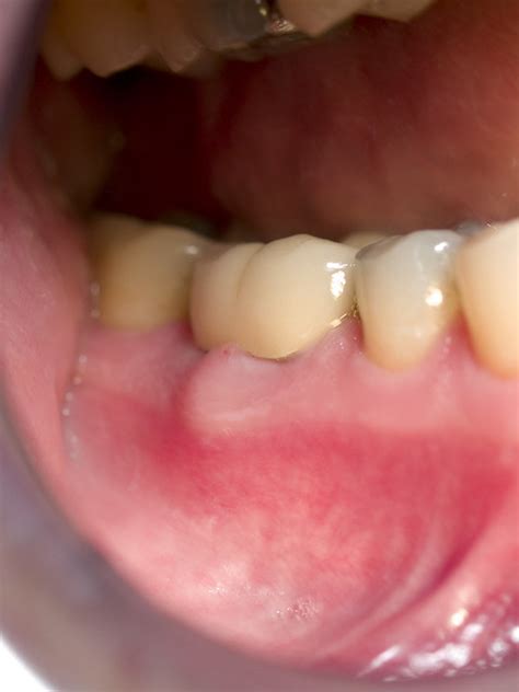 gingival abscess - a photo on Flickriver