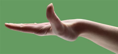Rupture of the Extensor Pollicis Longus (EPL) tendon – Fife Virtual Hand Clinic