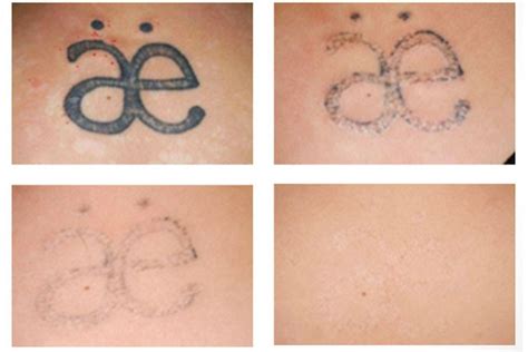 Wahrnehmung Bewundernswert Eigentum tatuajes eliminados con laser ...