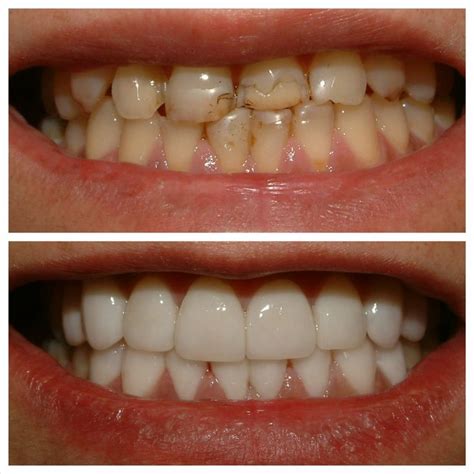 Composite Resin Veneers Before And After | Before And After