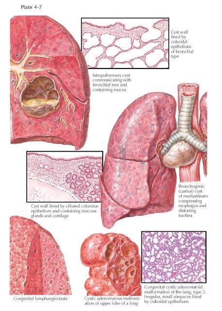 Congenital Lung Cysts Congenital lung cysts may be differentiated into ...