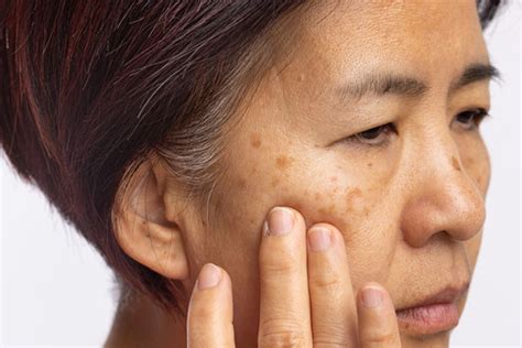 Melasma: What are the best treatments? - Harvard Health