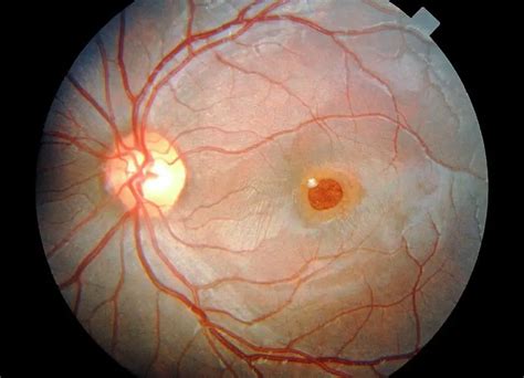 Ophthalmoscopy of the fundus: types, indications, how it is performed ...