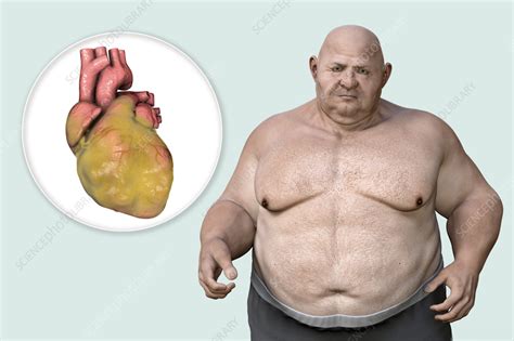 Fatty heart in overweight man, illustration. - Stock Image - F037/5693 - Science Photo Library