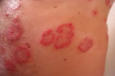 Psoriasis Symptoms & Treatment Options | Schweiger Dermatology