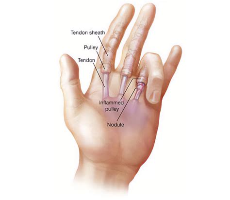 Trigger Finger Causes Treatment And Remedies - vrogue.co