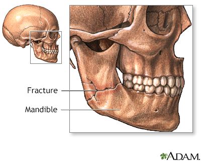 Broken or dislocated jaw - UF Health