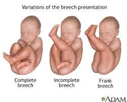 What to do if my baby is breech? – Healthy Mother