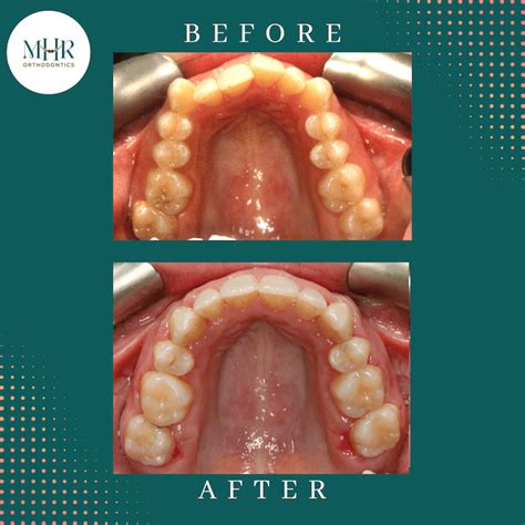 Before and After Orthodontic Treatment Photos - MHR Orthodontics