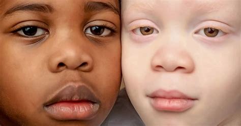 Twins With Different Skin Colors Astonished Their Mom When They Were ...